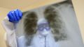 В Крыму фиксируют рост заболеваемости ковидными пневмониями