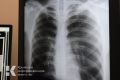 Пациенты симферопольской больницы жалуются на неработающий рентген-аппарат