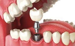 Имплантация зубов и особенности её проведения