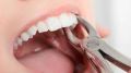Какие различия в удалении зубов мудрости и обычных: 10 необычных фактов