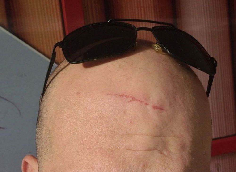 Житель Симферополя разбил голову из-за низко установленного знака