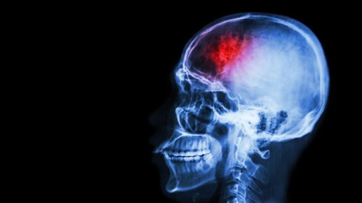 Глобальная эпидемия инсультов: в чем спасение