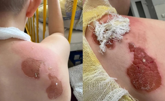 5-летний мальчик получил серьезные ожоги в севастопольском бассейне 5-летний мальчик получил серьезные ожоги в севастопольском бассейне