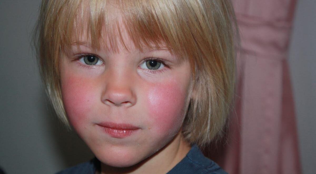 Пока родители переживают из-за простуды и гриппа, рядом ходит куда более коварная штука — парвовирусная инфекция